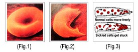 Fig 1 sickle cell